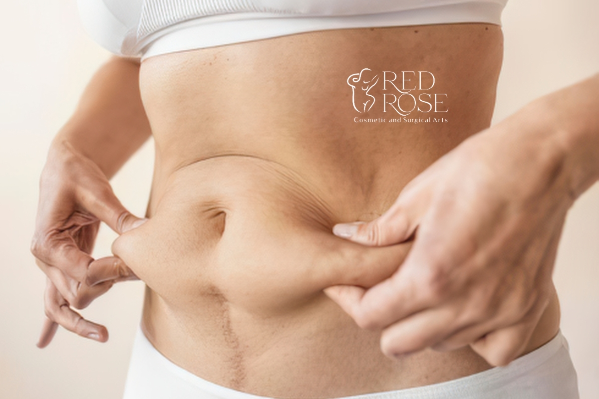 tummy tuck Miami